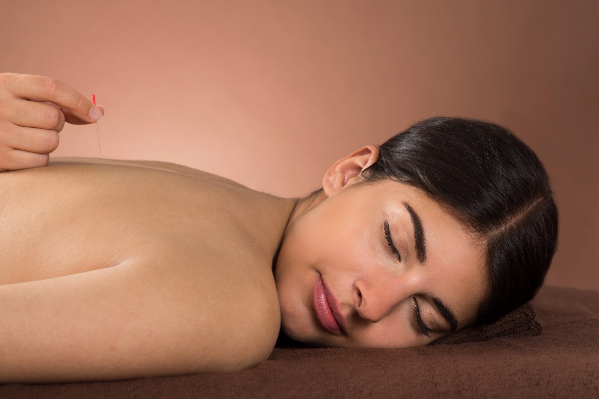 Woman receiving acupuncture treatment for stress management - GEO case study results for women-owned wellness practice
